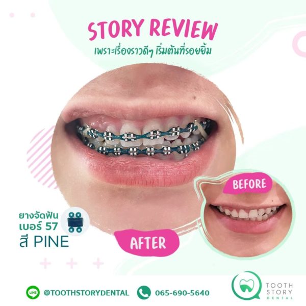 รีวิวสียาง – Tooth Story Dental Clinic