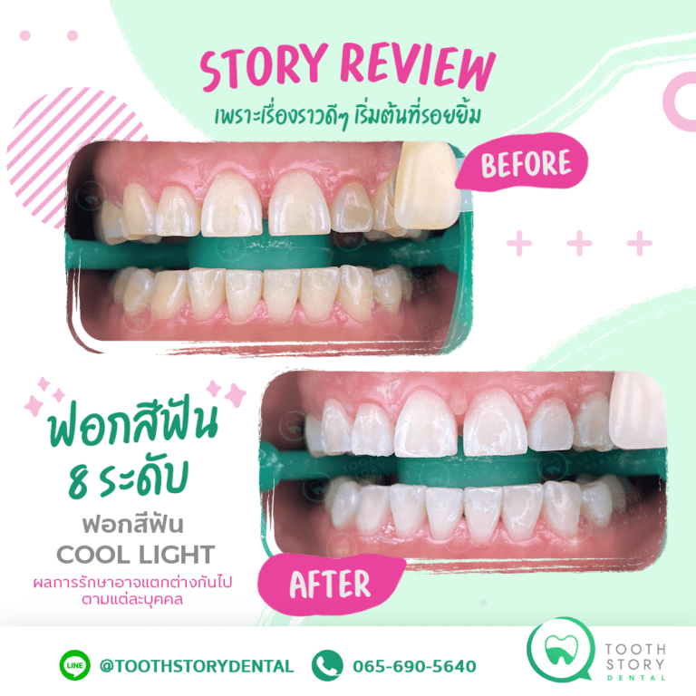 รีวิวฟอกสีฟัน Cool Light ฟันขาวขึ้น 8 ระดับ