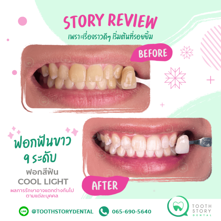 รีวิวฟอกสีฟัน Cool Light ฟันขาวขึ้น 9 ระดับ